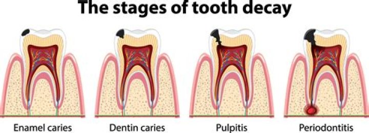 At what age do your teeth start decaying?