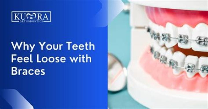 Do braces move your teeth everyday?