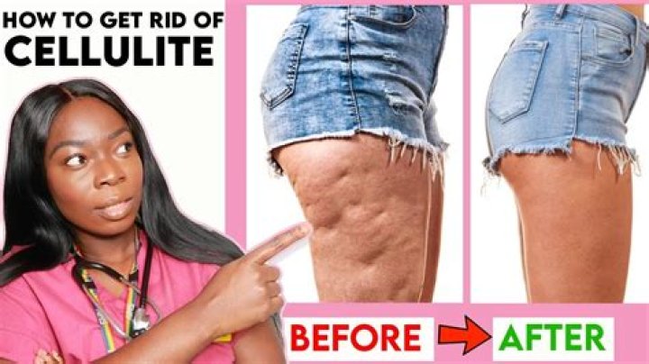 Do squats reduce cellulite?