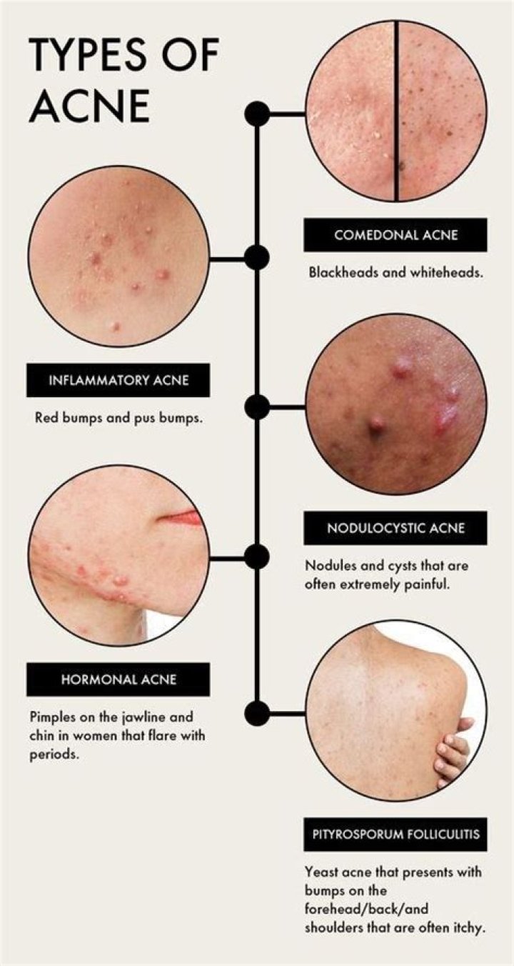 Does acne have any benefits?