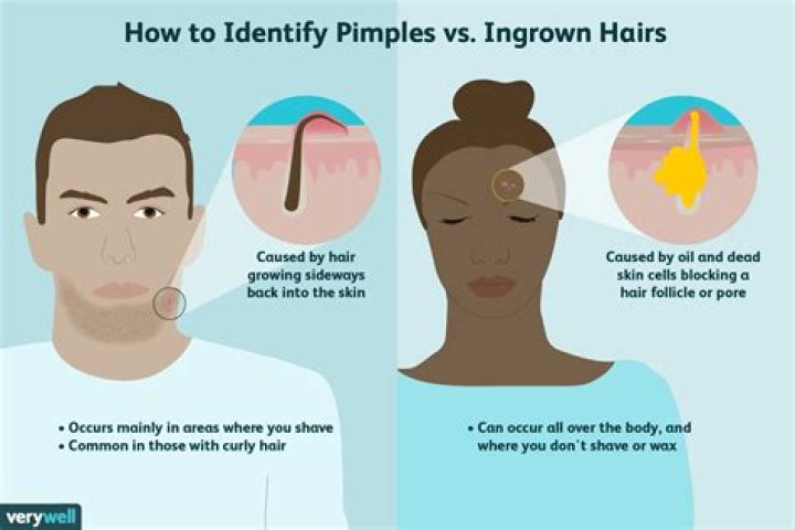 Does Nair cause ingrown hairs?