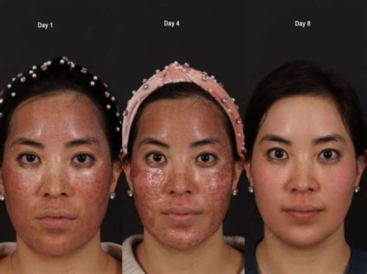 How many days after Fraxel do you peel?