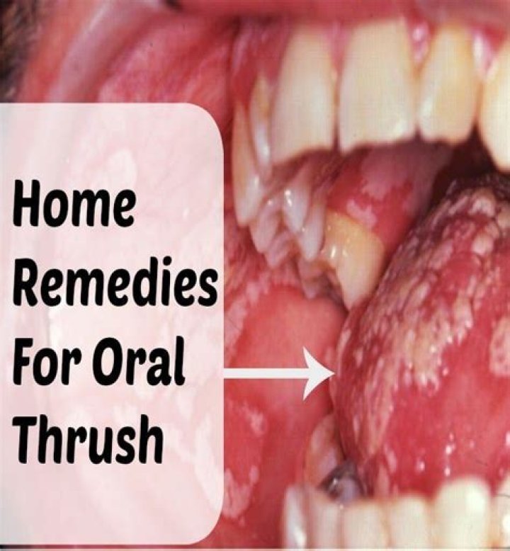 What does oral thrush look like?
