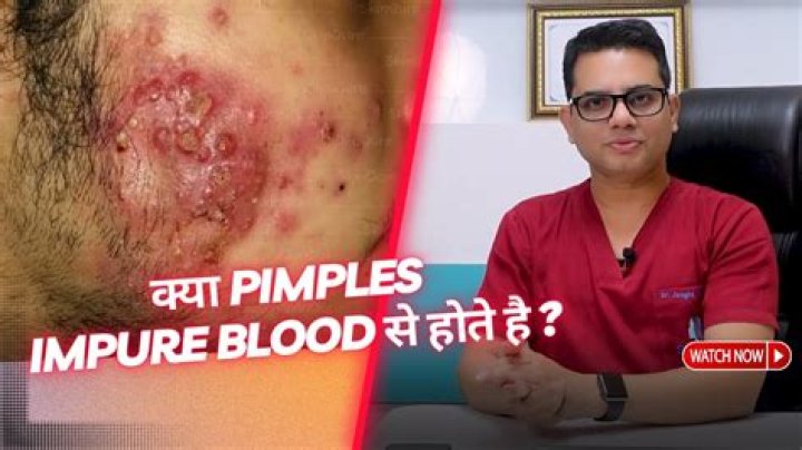 What happens if you pop a pimple and blood comes out?