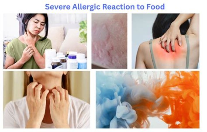 What should I do if I have a severe allergic reaction to the COVID-19 vaccine?