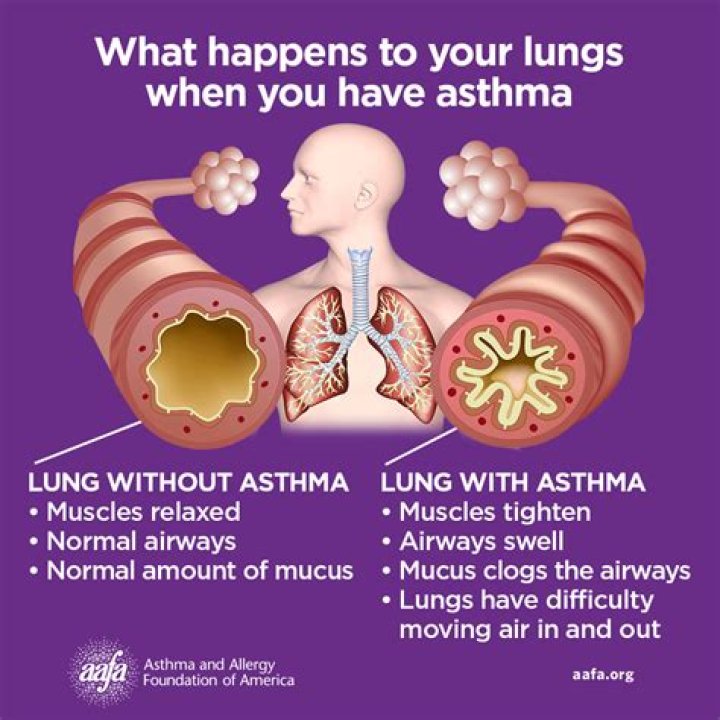 Will losing weight help my asthma?